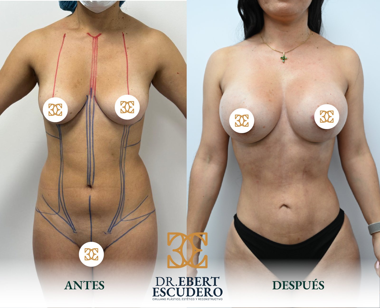 antes y depsues 95-34
