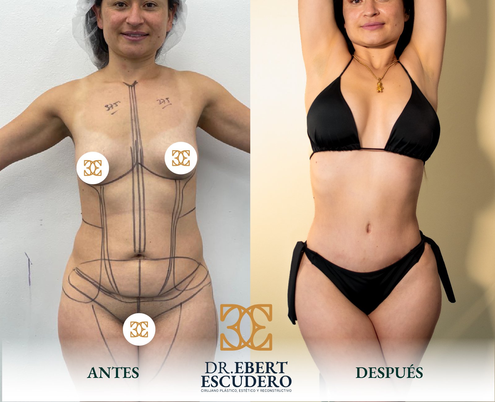 antes y despues 93-21